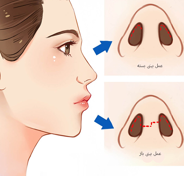 انواع عمل بینی چیست؟