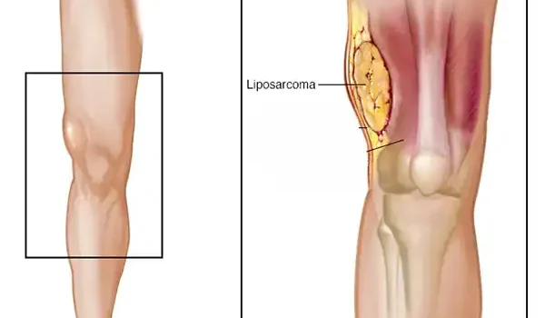 لیپوسارکوم چیست؟