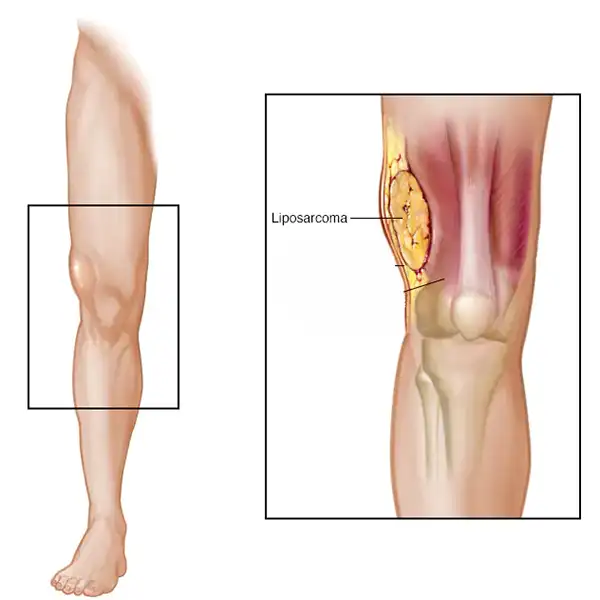 لیپوسارکوم چیست؟