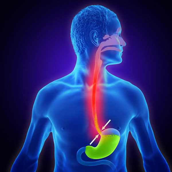 رفلاکس معده + علائم + درمان