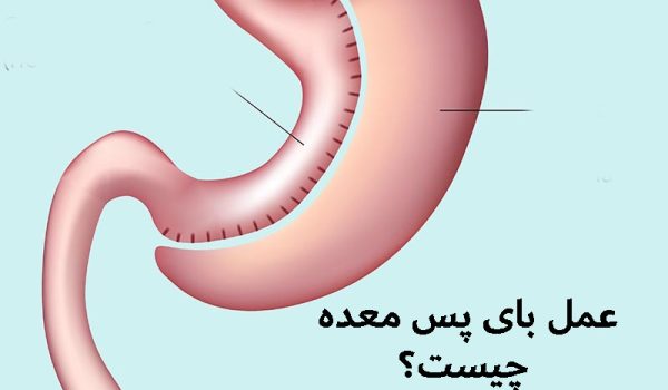 هزینه عمل بای پس معده