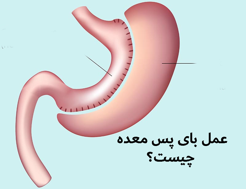 هزینه عمل بای پس معده